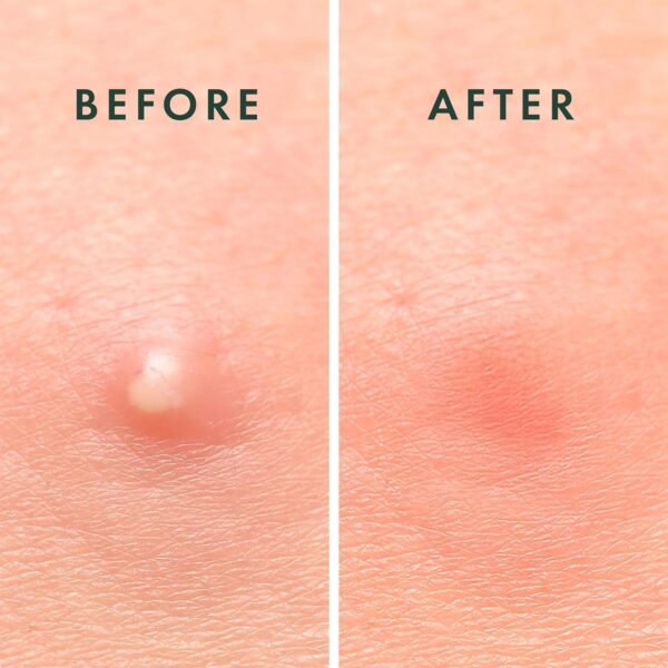 Rael Pimple Patches, Miracle Invisible Spot Cover - Image 3